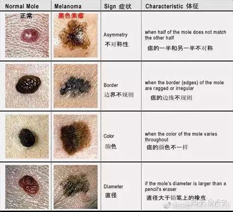 如何消痣|痣是什麼？會變成黑色素瘤？7種一定要除的痣